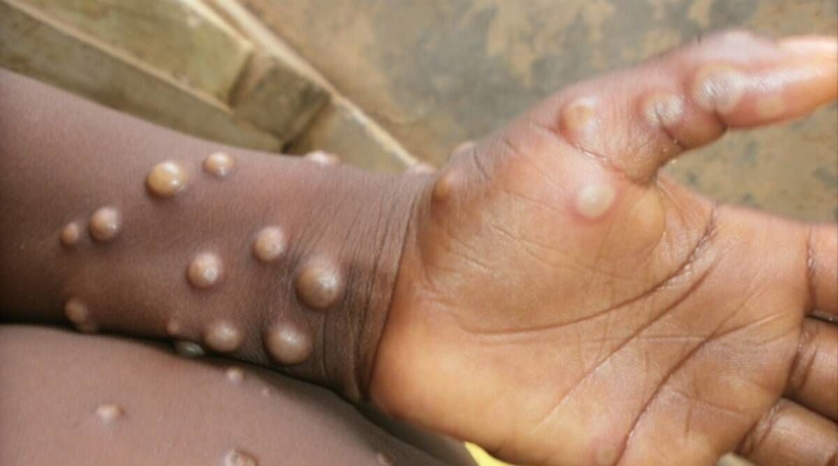 New York urges WHO to ‘immediately’ rename monkeypox